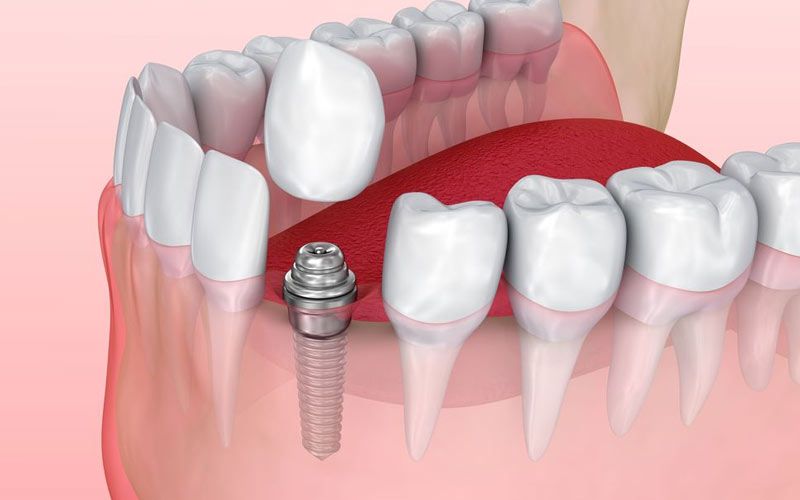 Dental Implants1