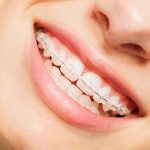 What is Better, Clear Braces or Invisalign?