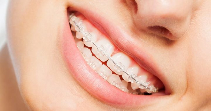 Clear Braces or Invisalign