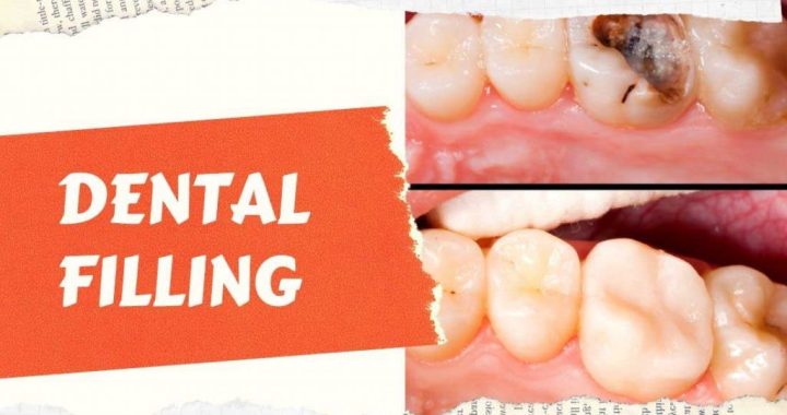 Dental Fillings