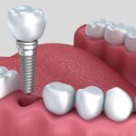 6 Great Reasons to Have Dental Implants Fitted in Sydney