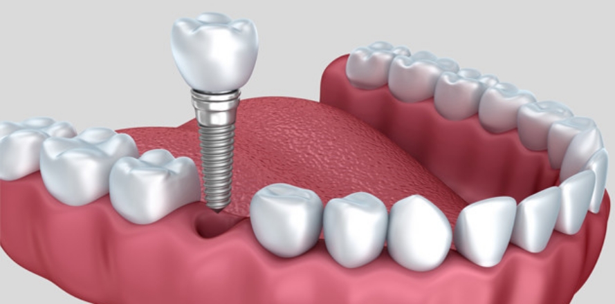 Dental Implants Fitted in Sydney